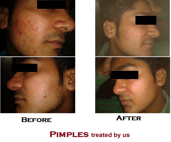 2012-11-08 20.32.54acne harshal krishna b 1