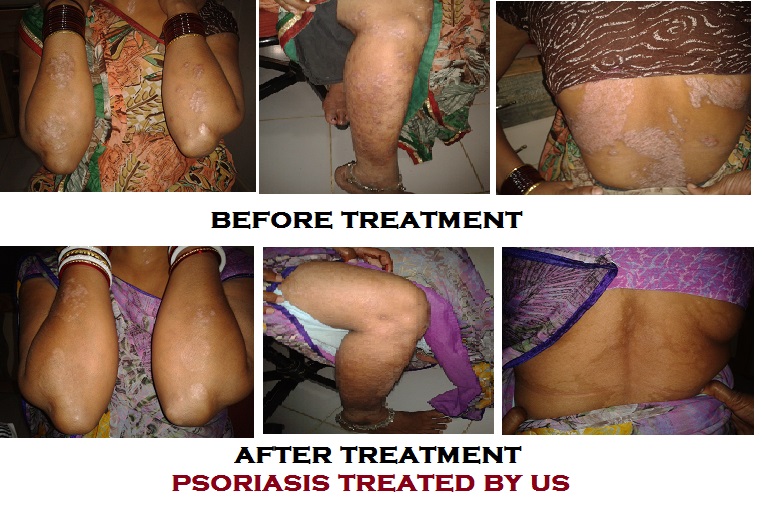 2012-12-13-19.11.47psoriasis-neha