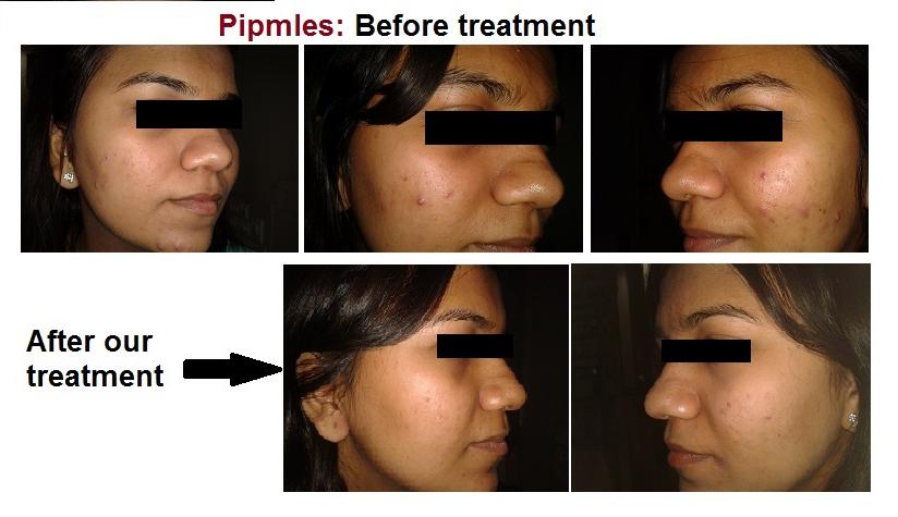 2013-09-18-20.20.49acne-mikita-krishna-b3