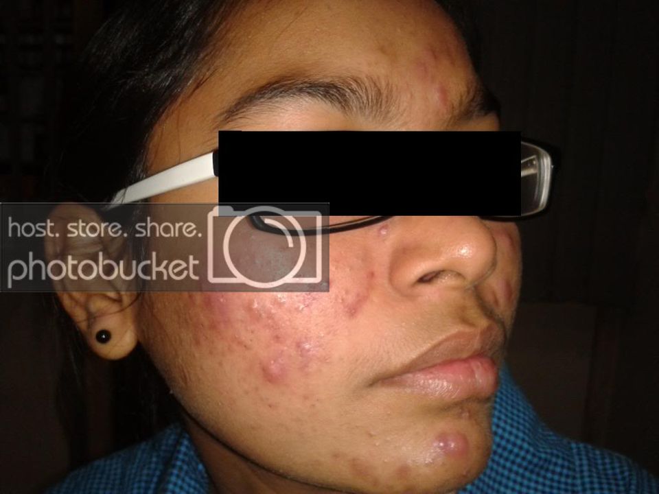 2013-10-30203754acnedipalikrishna